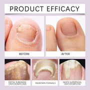 Bee Venom Nail Fungus Solution 10ml Each BUY 1 GET 1 FREE