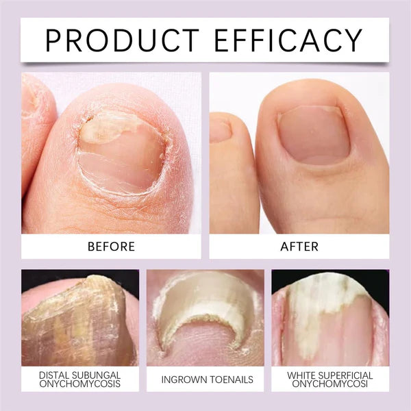 Bee Venom Nail Fungus Solution 10ml Each BUY 1 GET 1 FREE